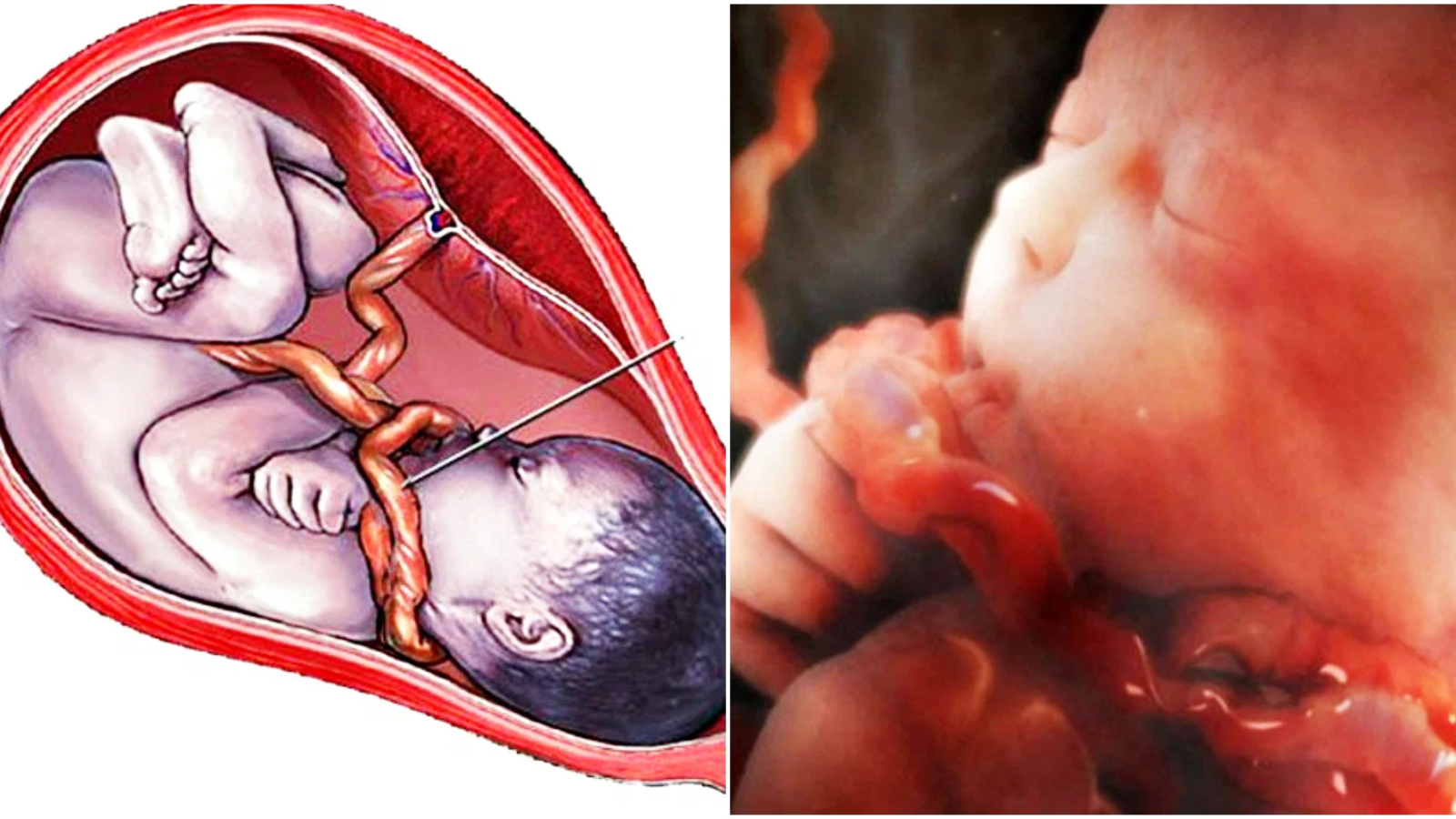 Nếu xoa bụng không đúng cách có thể làm tăng nguy cơ dây rốn quấn cổ nếu thai nhi vận động nhiều