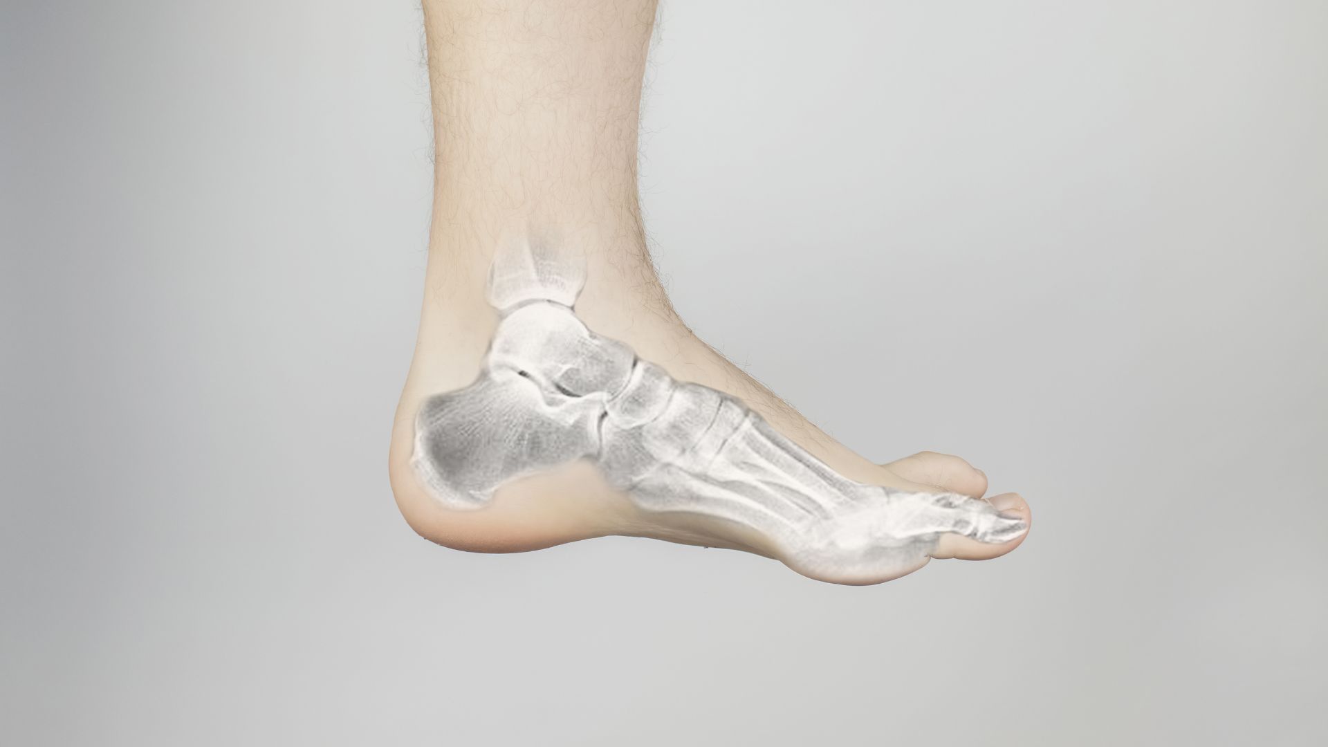 Xquang xương bàn chân giúp xác định tổn thương xương do chấn thương