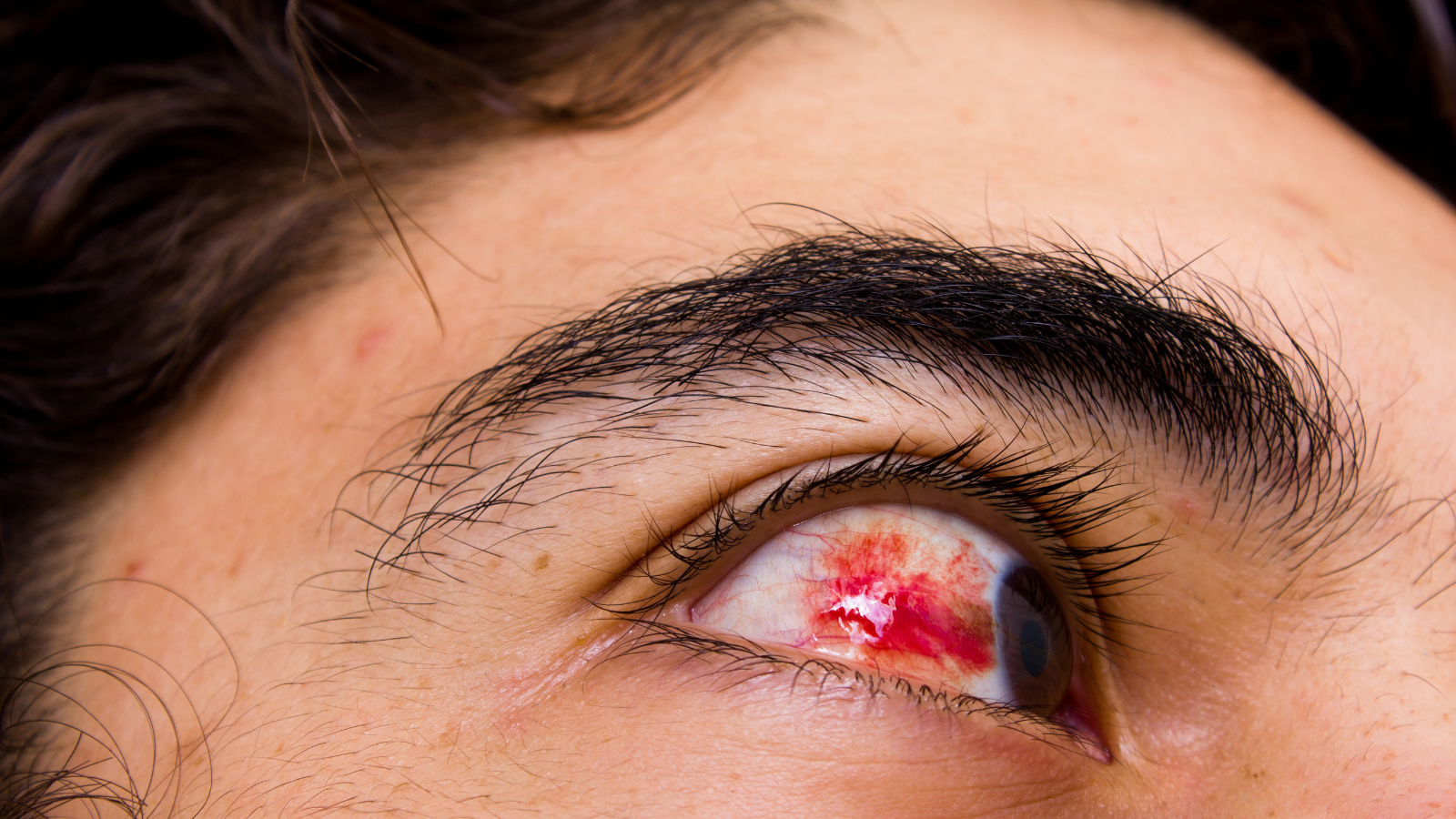 Xuất huyết dịch kính xảy ra khi máu rò vào khoang dịch kính