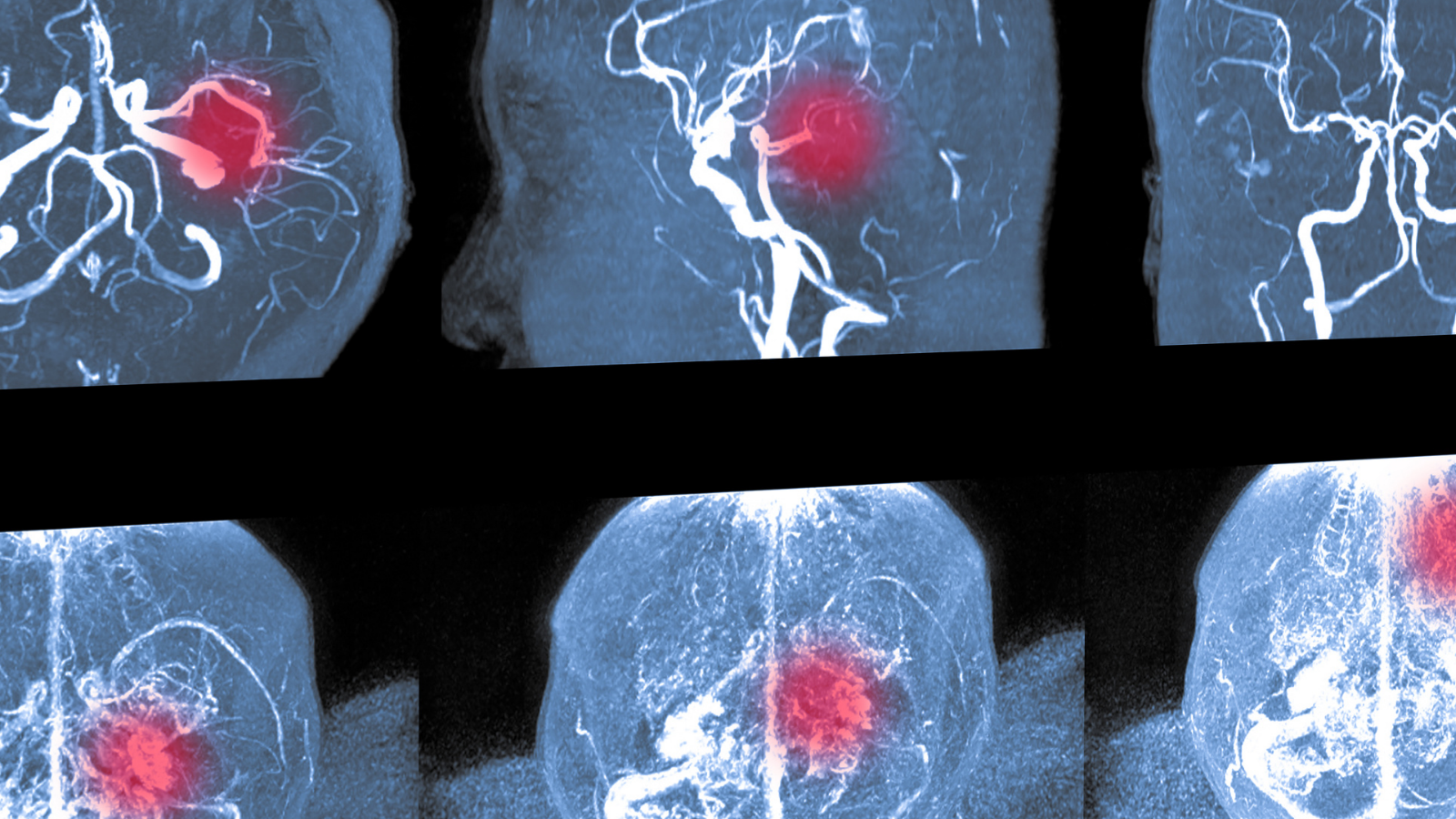 Cấu trúc não trẻ sơ sinh và vị trí dễ xảy ra xuất huyết não