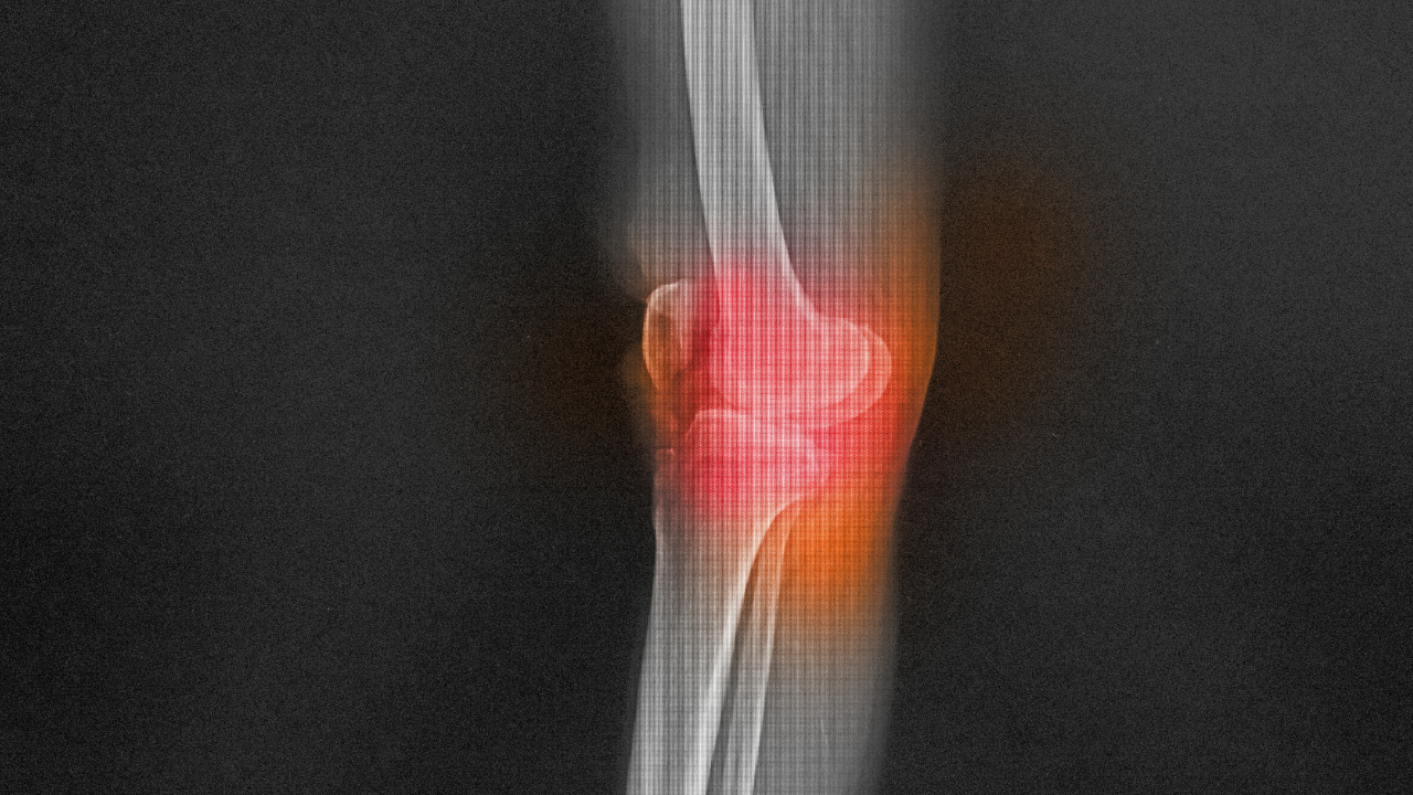 Xương bánh chè gồm có hai mặt, hai bờ, một đỉnh và một đáy