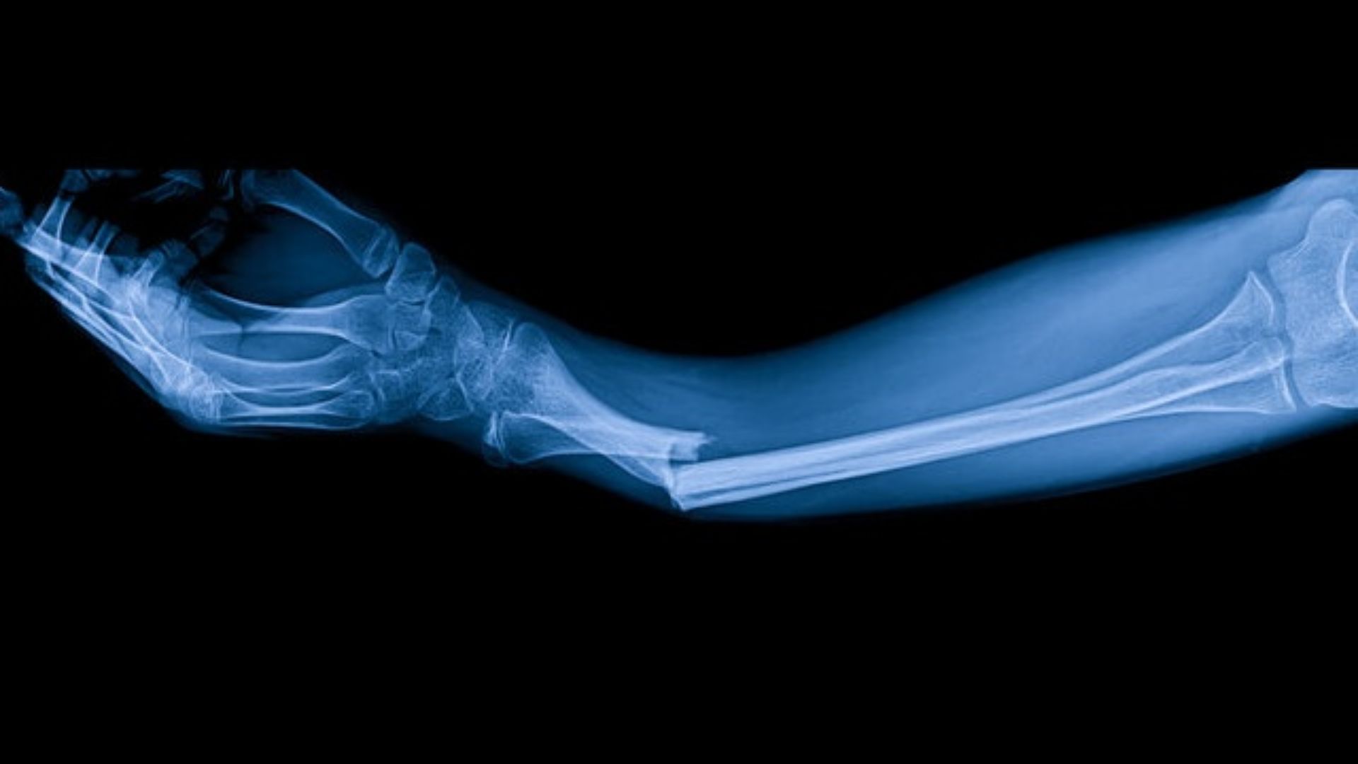 Gãy xương cánh tay thường xảy ra do té ngã hoặc chấn thương thể thao