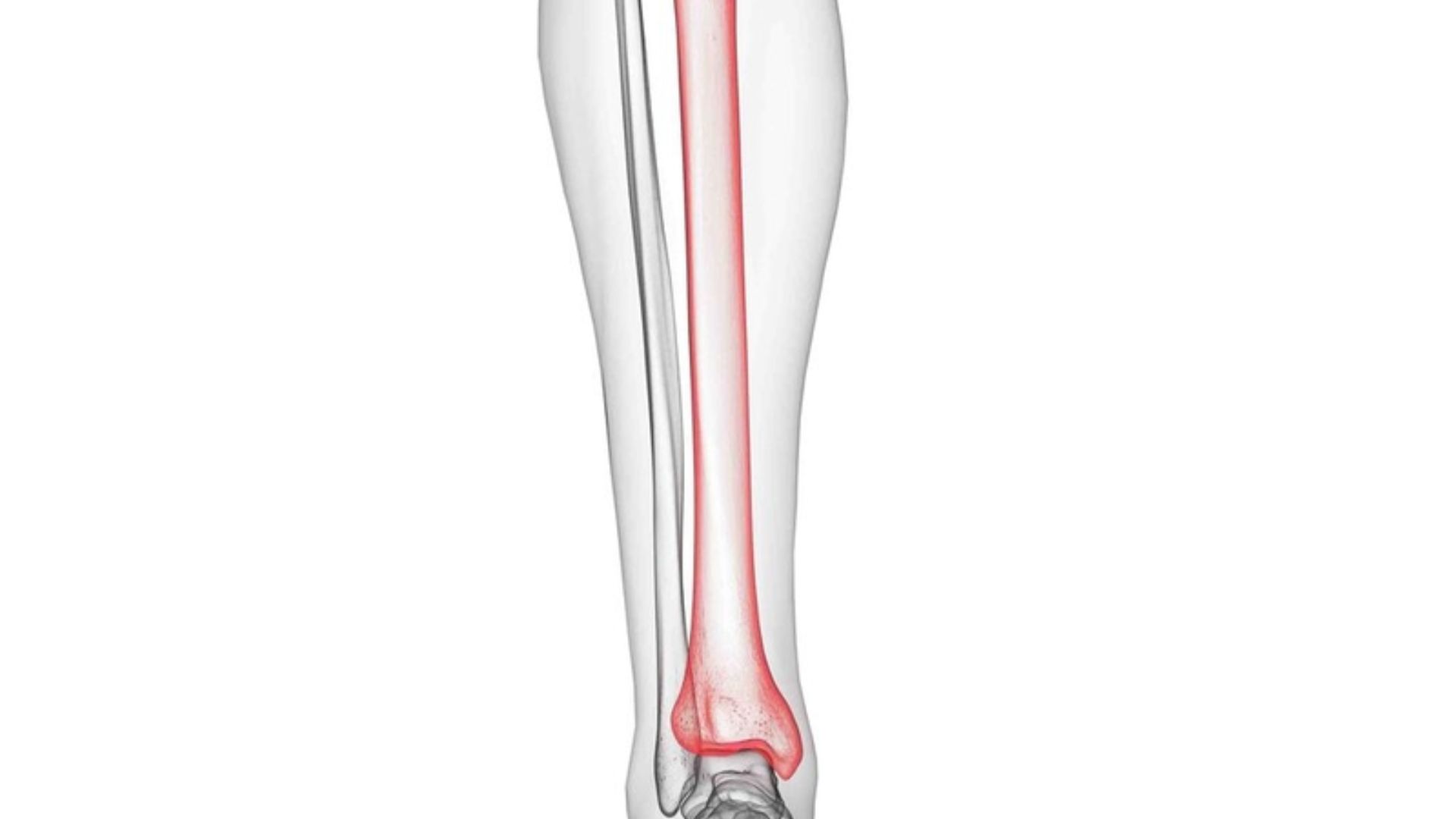 Xương chày là một trong các xương quan trọng ở chi dưới và rất dễ bị gãy