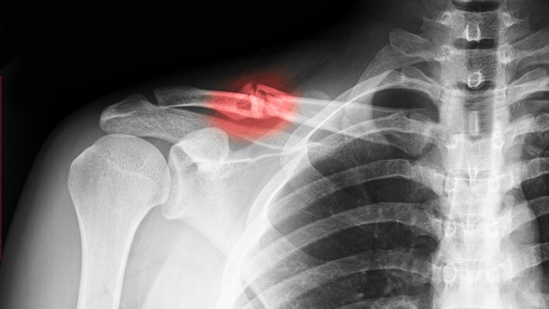 Gãy xương đòn là một trong các loại gãy xương phổ biến hiện nay