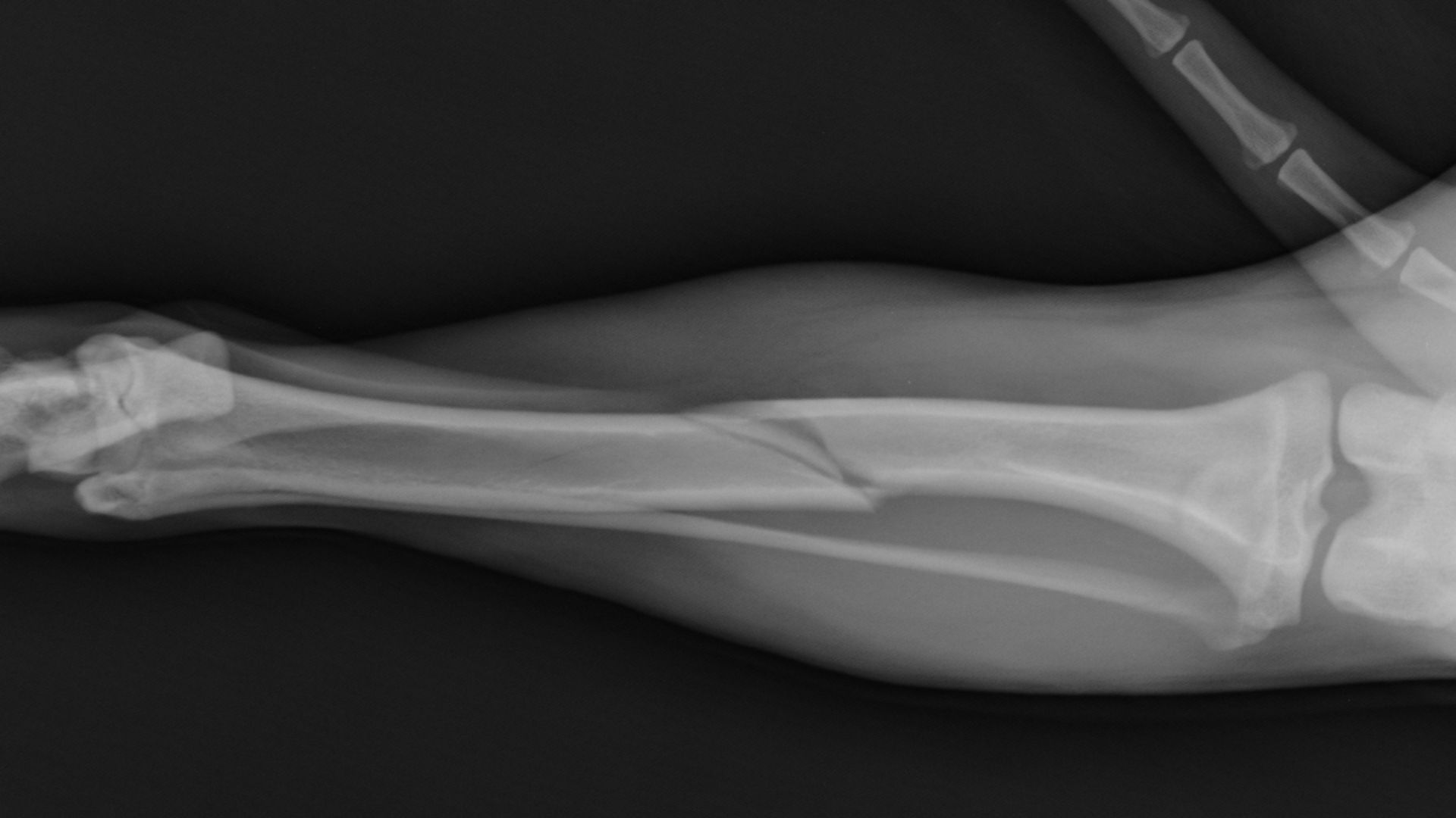 Gãy xương là một trong những vấn đề thường gặp về xương ống đồng