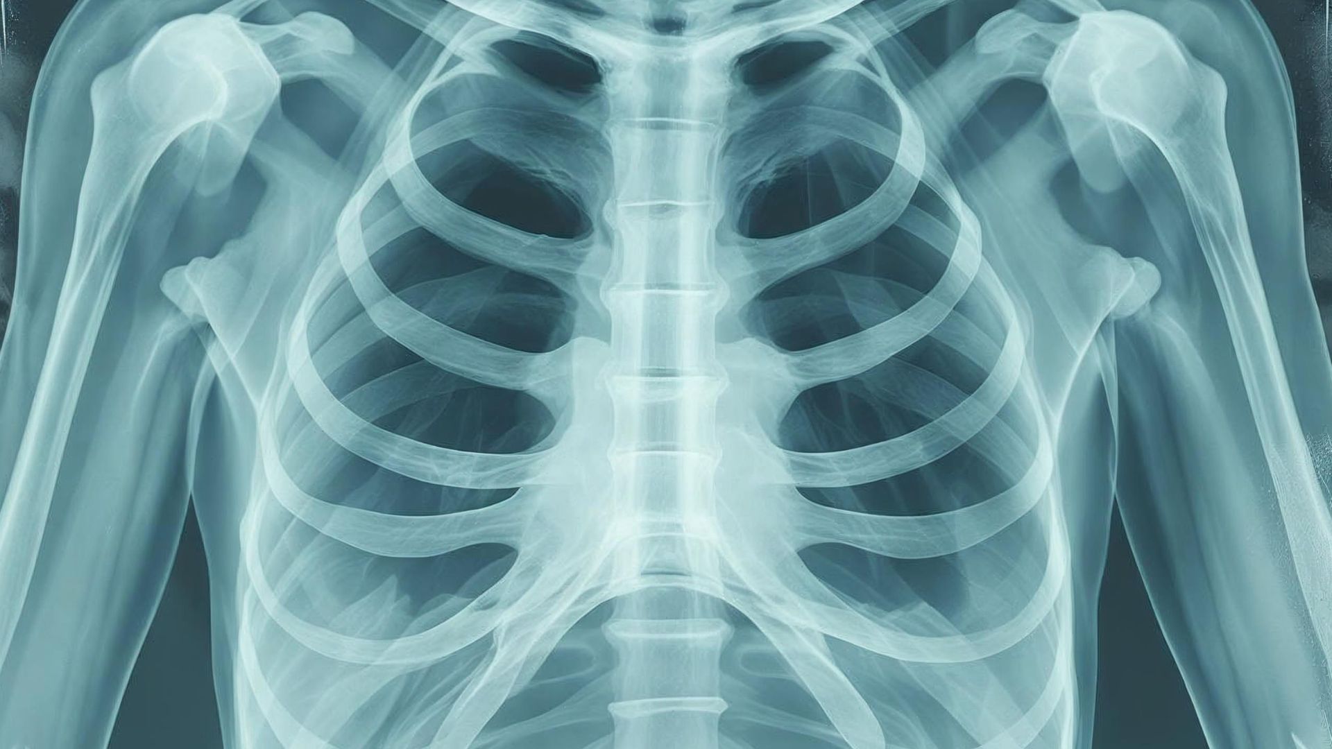 U xương sườn thường được chẩn đoán dựa trên kết quả X-quang và sinh thiết