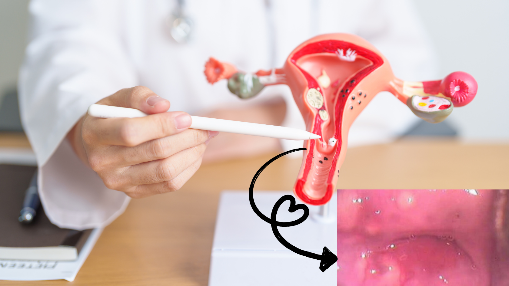 Hình ảnh siêu âm nang Naboth cổ tử cung