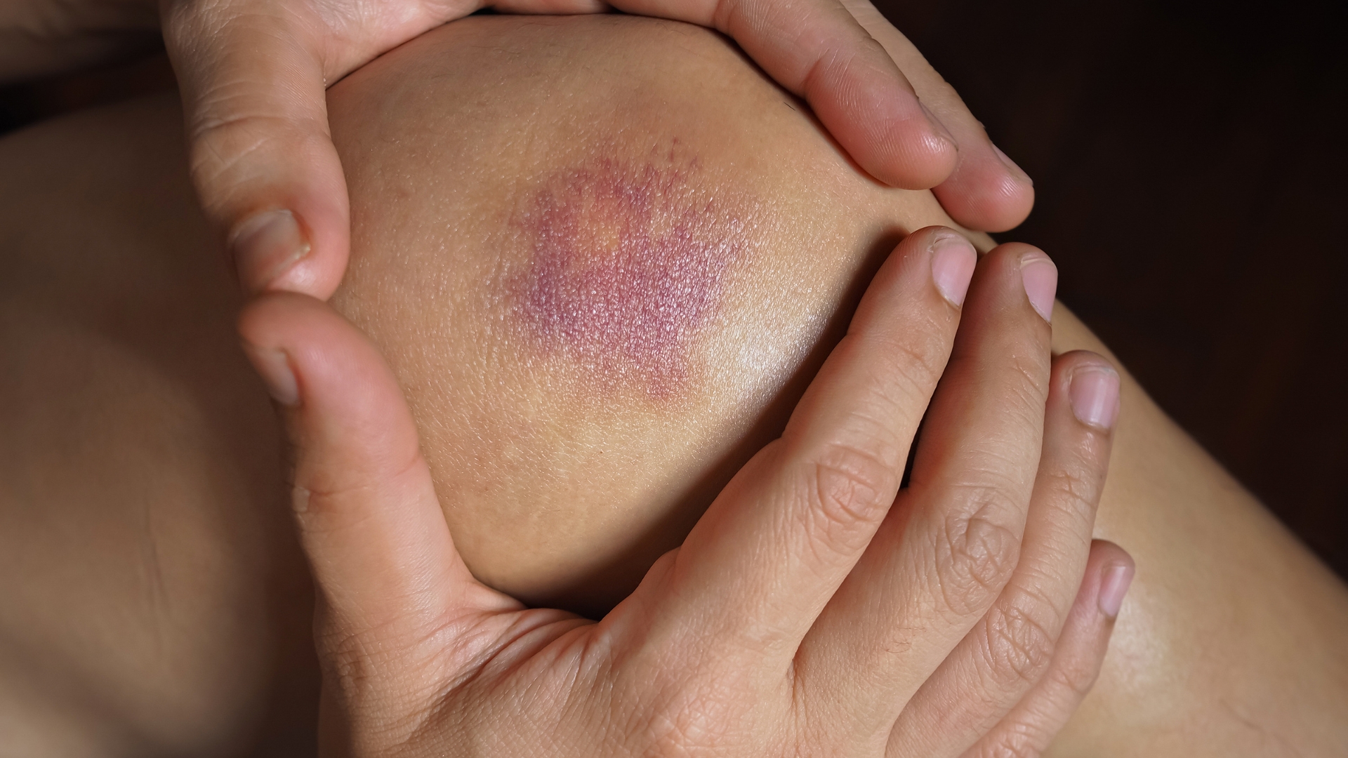 Dễ bầm tím dưới da dù chỉ da chạm nhẹ có thể là dấu hiệu của việc giảm đông máu