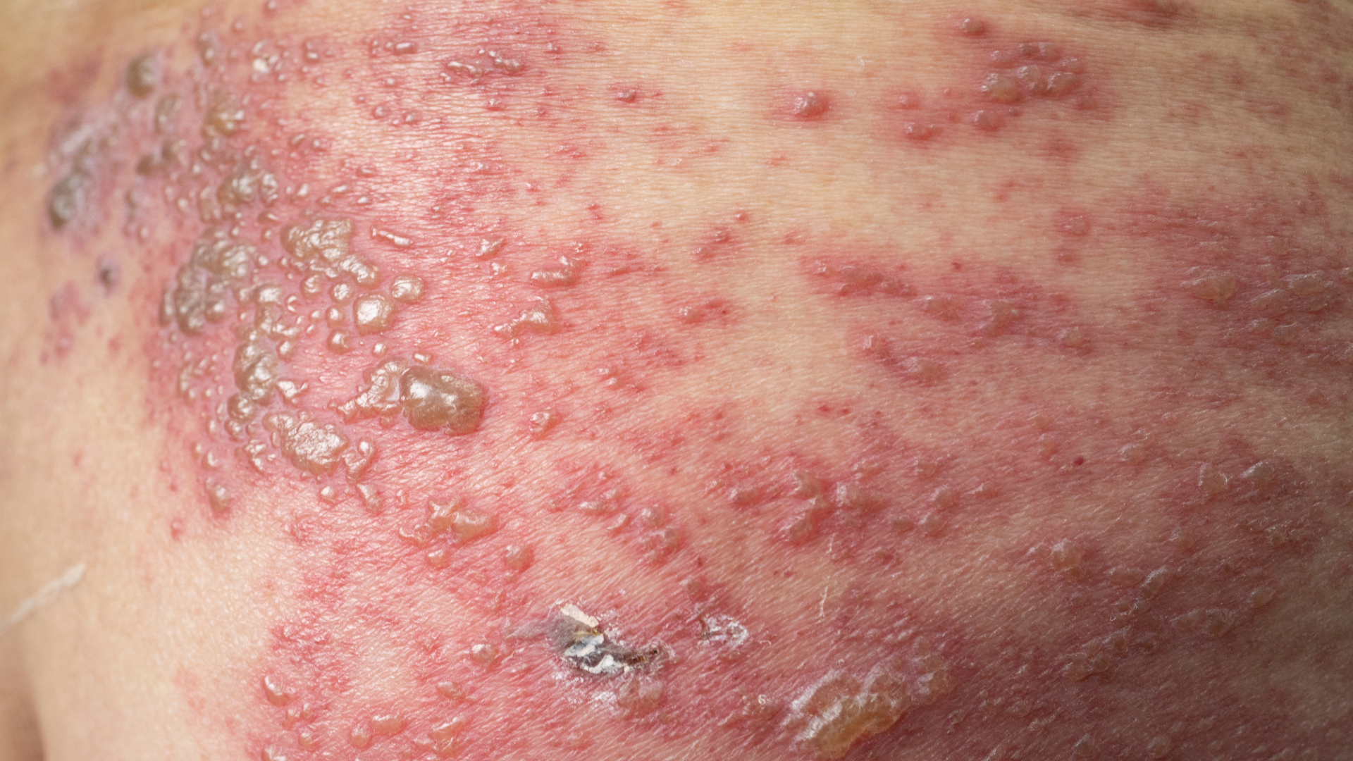 Dấu hiệu zona thần kinh ở mông cần nhận biết sớm