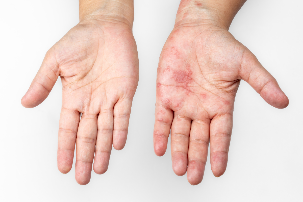 zona-than-kinh-o-tay-nhan-biet-bang-mat-thuong-qua-3-giai-doan 2.png